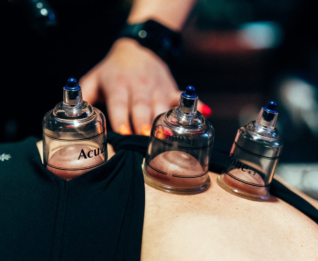 Three cupping therapy cups applied along a clients back