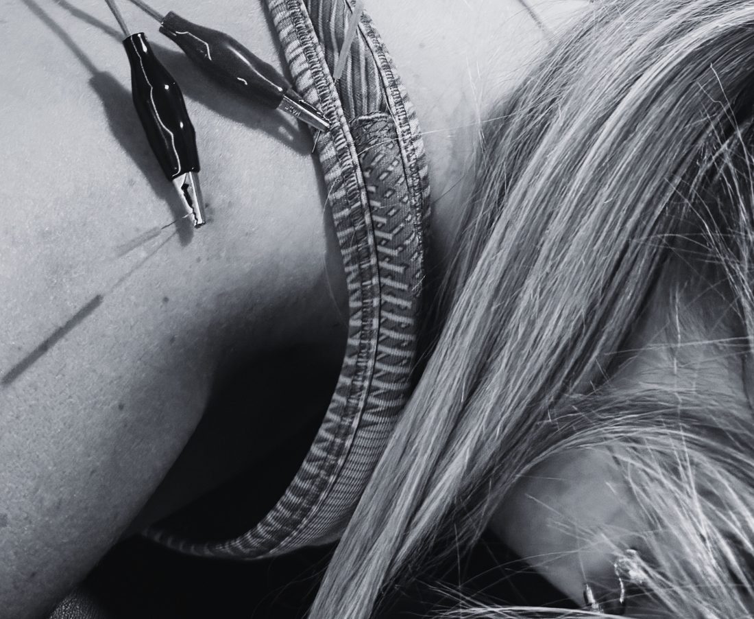 Electrical stimulation leads clipped to needles along a clients upper back